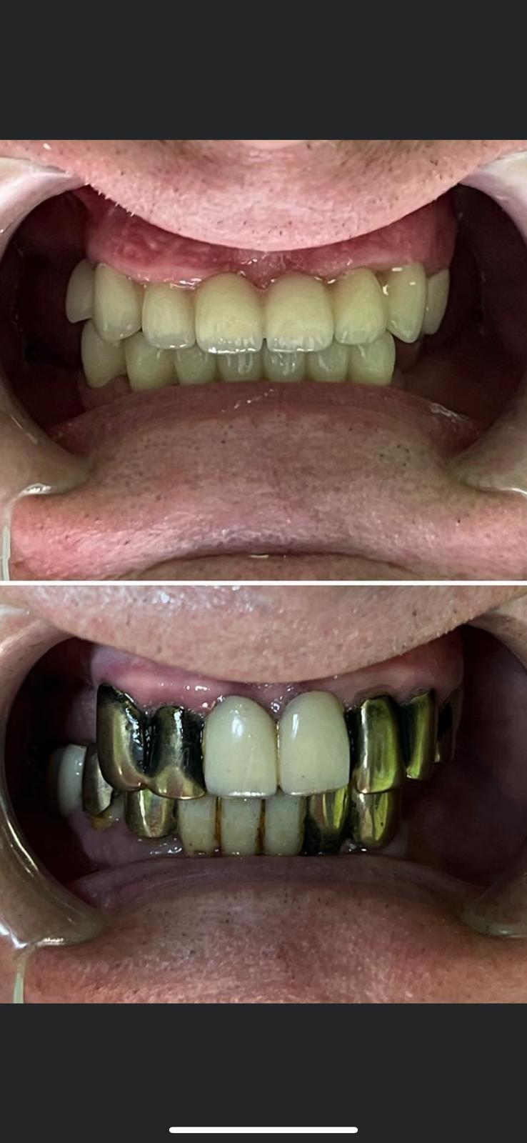 Coroane mixte ceramică-metal — Pavăl Dent