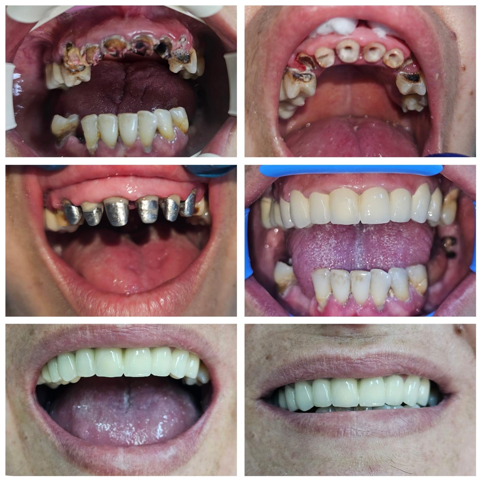 Reabilitare orală totală — Pavăl Dent