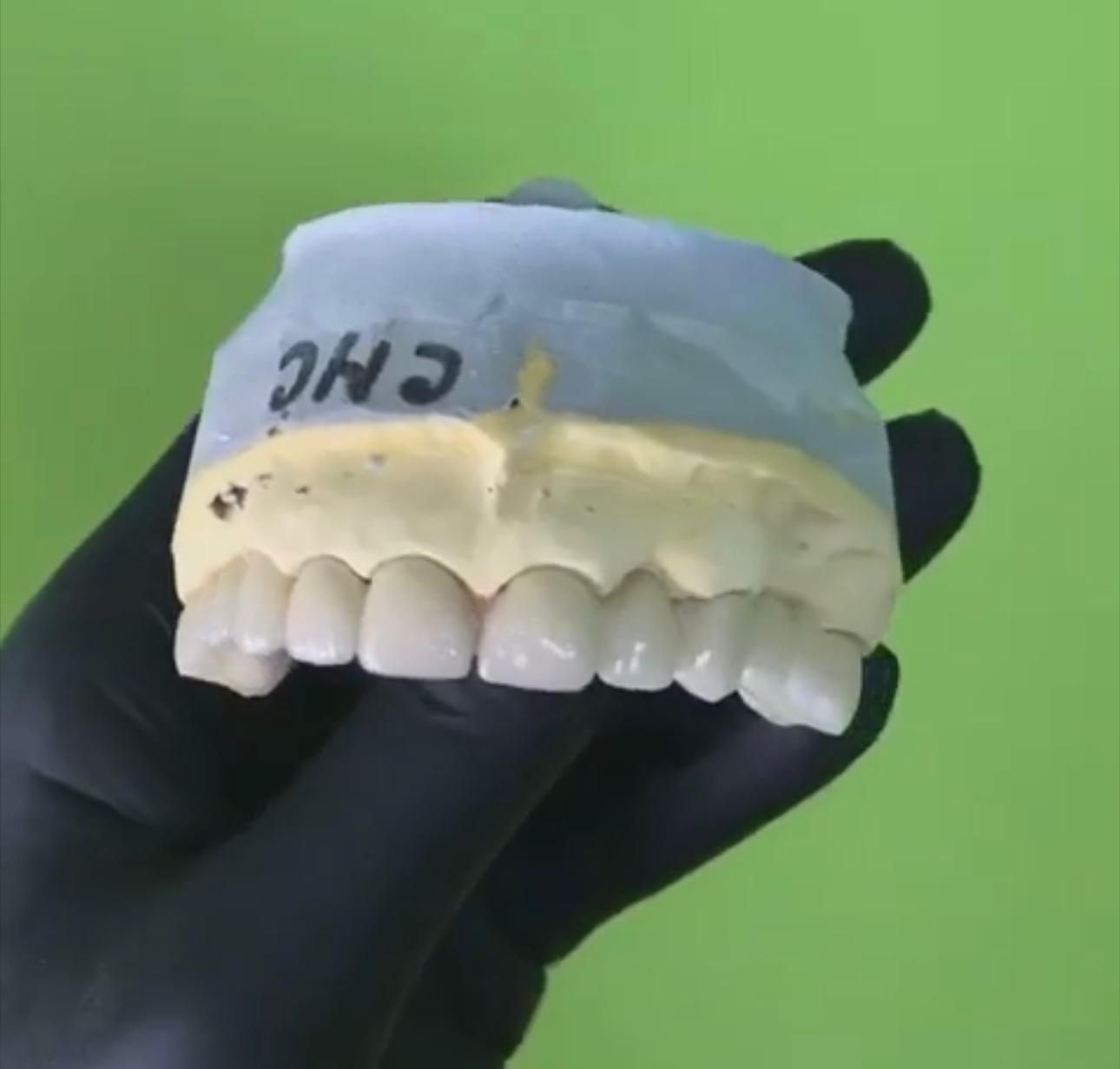 Ceramică pe model — frontal — Pavăl Dent