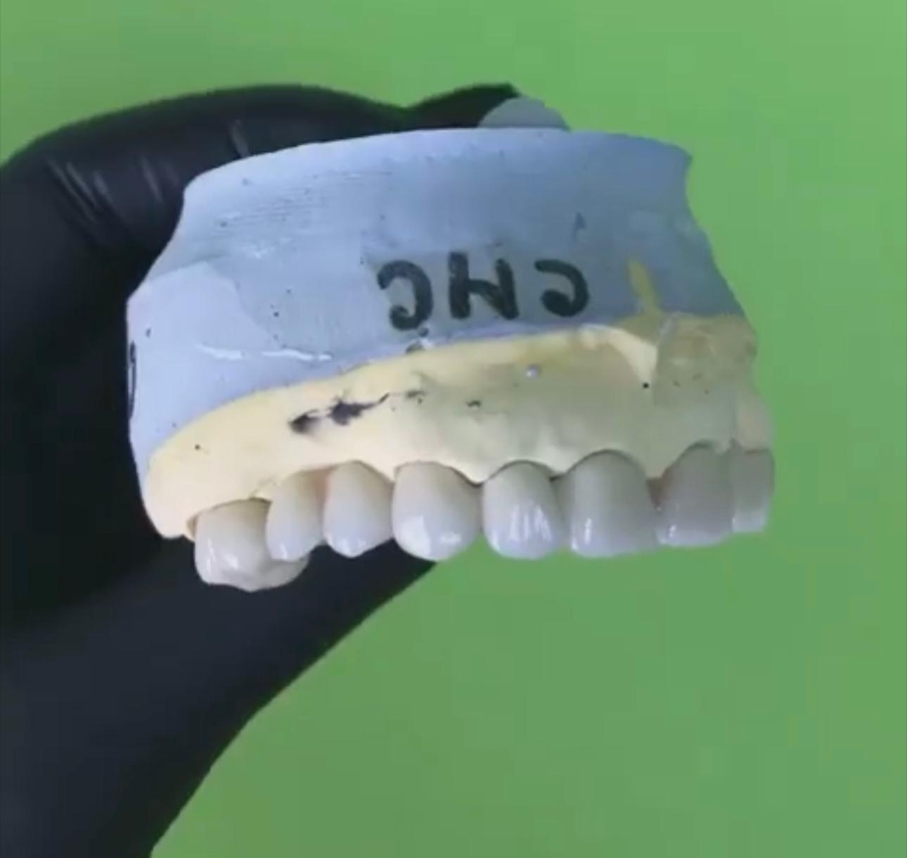 Ceramică pe model — lateral — Pavăl Dent